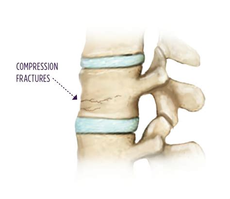 fraktur kompresi  Fraktur kompresi (Wedge fractures) – adanya kompresi pada bagian depan corpus vertebralis yang tertekan dan membentuk patahan irisan